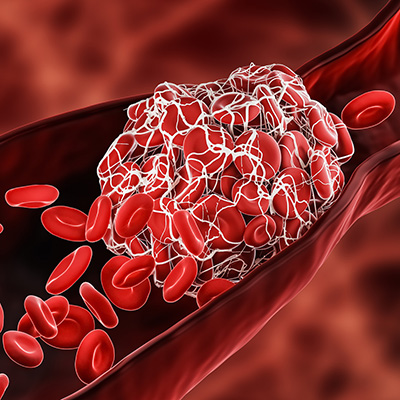 Various Strategies to Treating Blood Clots with Natural Medicines