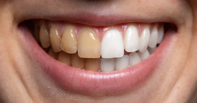 Five drinks that discolor teeth and advice on maintaining white teeth