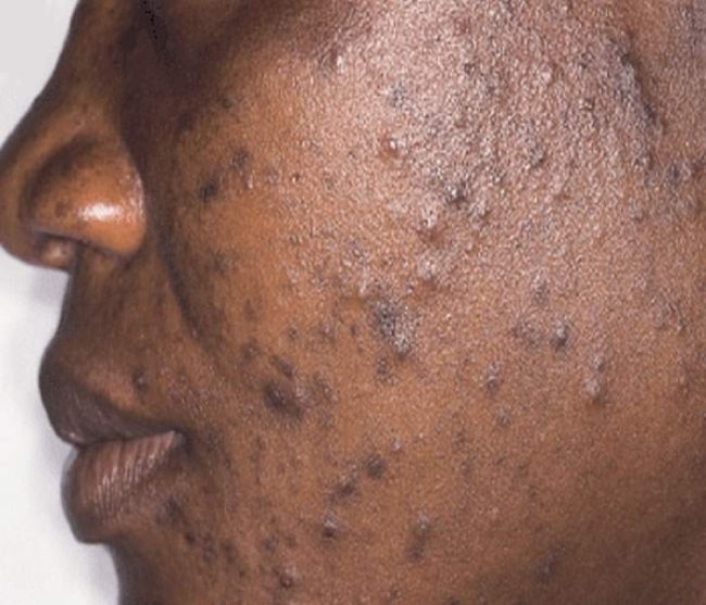 These are some things you should not do if you want to avoid getting acne.